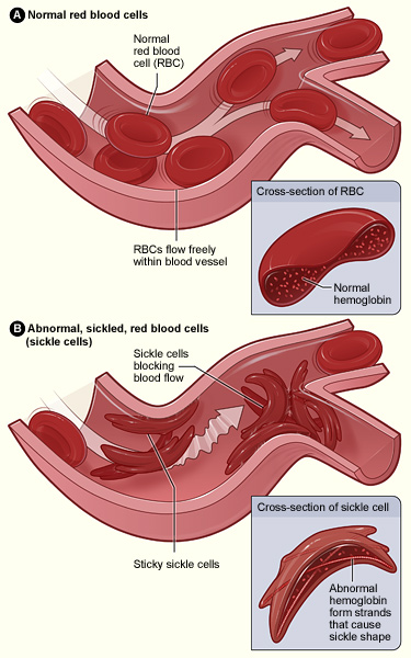 sickle-cell